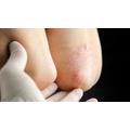 Psoriasis, eczema, wart, skin disease reviews